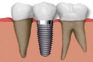implante dental