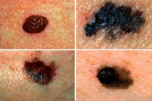 tipos de Cáncer