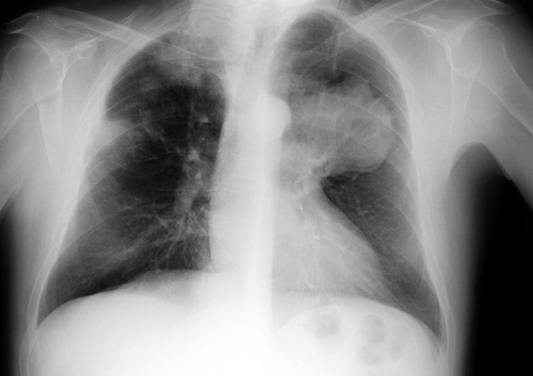 Cáncer de pulmón
