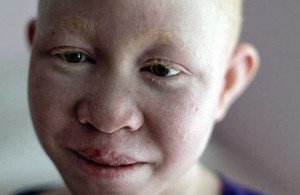 Albinos