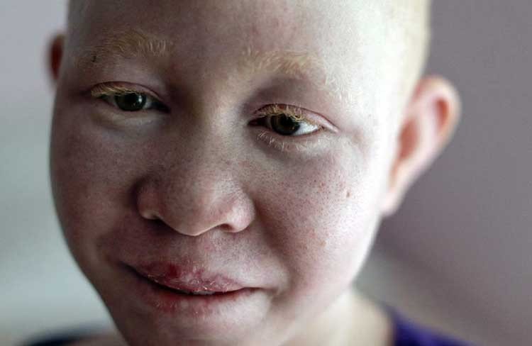 Albinos