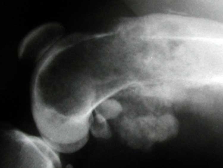 cáncer de hueso