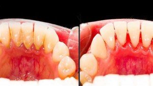la placa Dental