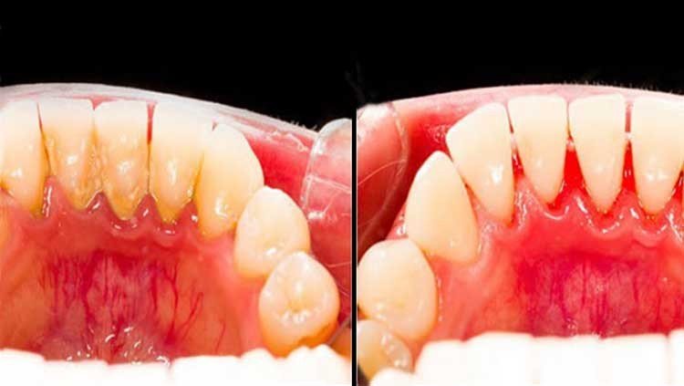la placa Dental