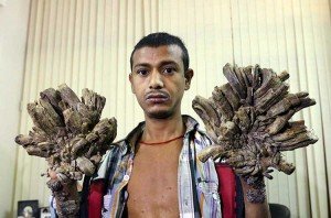 Hombre árbol recibirá tratamiento especializado