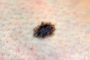 Supervivencia de cáncer de piel salta de 1% a 40%