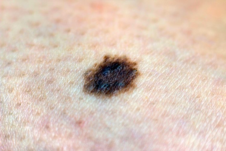 Supervivencia de cáncer de piel salta de 1% a 40%