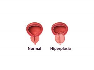 Nuevo tratamiento para la hiperplasia de próstata
