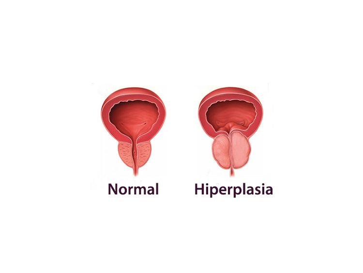 Nuevo tratamiento para la hiperplasia de próstata