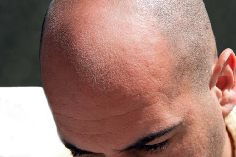 Medicamento para la calvicie o para la artritis