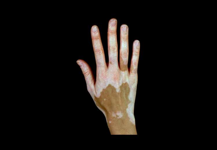 ¿Qué es el vitíligo? Manchas blancas en la cara