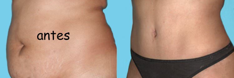 Liposucción en brazos, papada, espalda y abdomen
