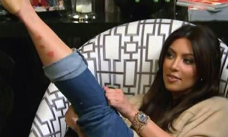 Cómo brota la psoriasis en Kim Kardashian?
