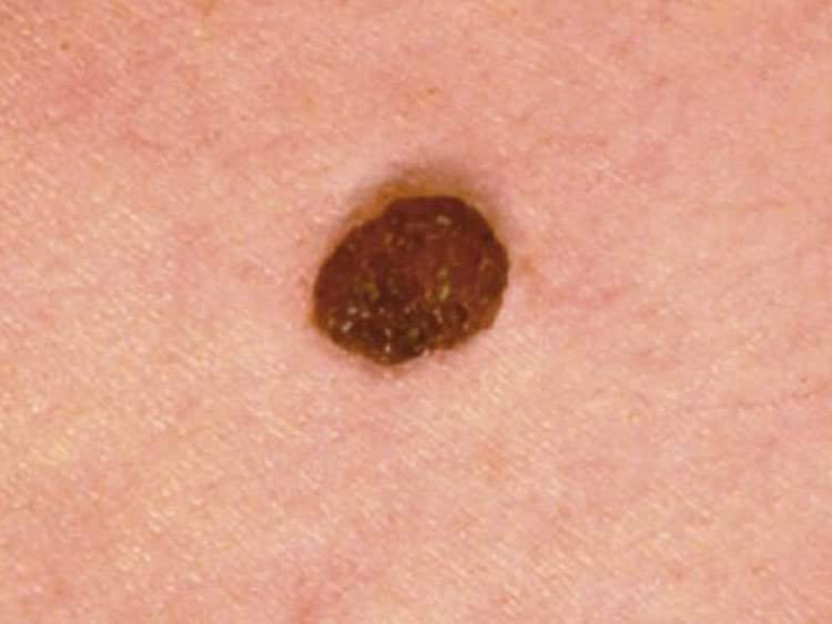 Cuál es la nueva droga para el cáncer de piel?