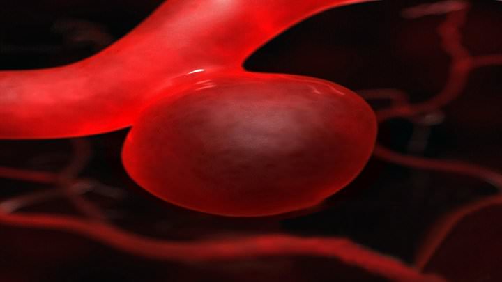 Cuáles son los síntomas de un aneurisma cerebral?