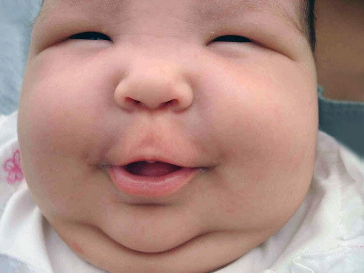 Bebé gordito: cuidado con la epidemia de obesidad