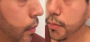 Trasplante de barba – una moda nueva